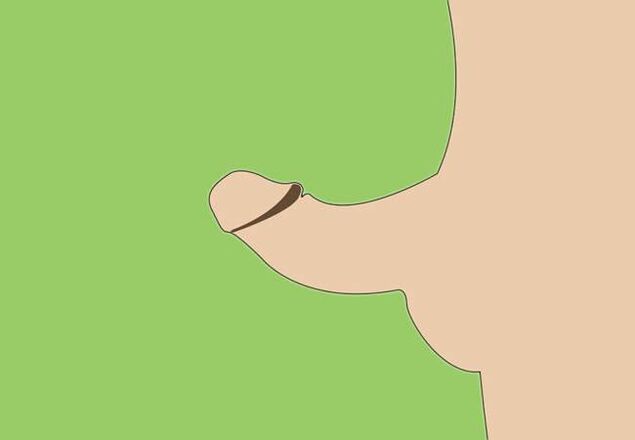 кривина на пениса като индикация за хирургично уголемяване